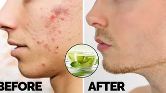 Green tea and honey to remove acne