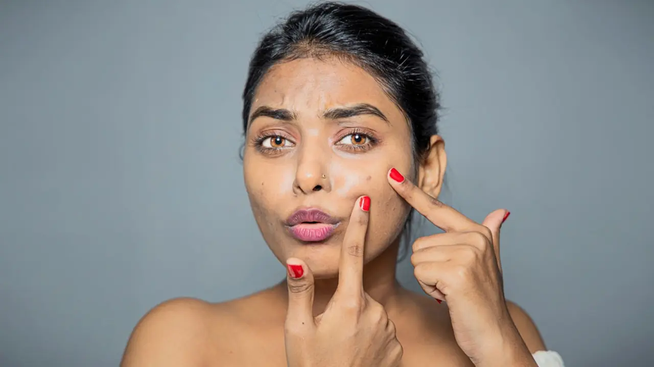 ব্রণ দূর করতে যে ৩ কাজ করবেন