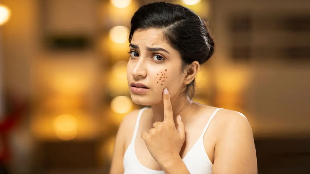 মুখের দাগ দূর করার ঘরোয়া উপায়