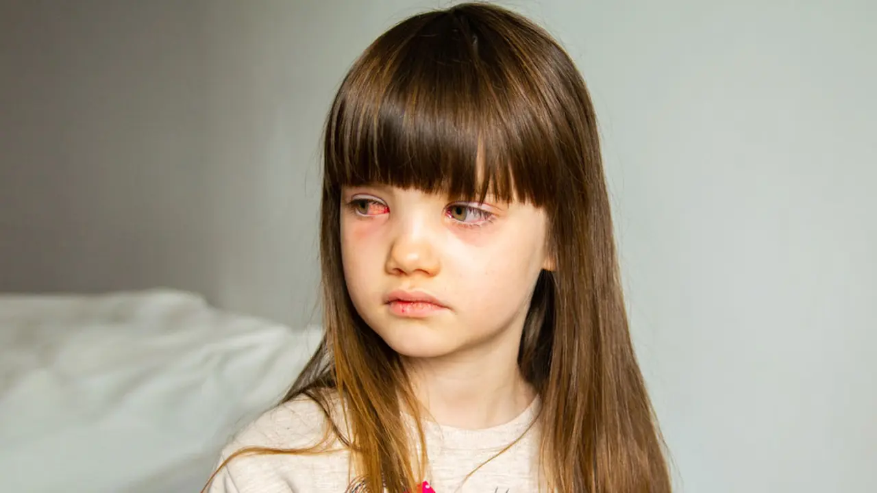 চোখ ওঠা সমস্যায় যেসব খাবার উপকারী | Pink eye home remedy