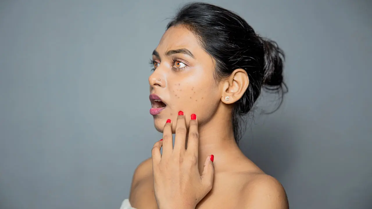 মুখে কালচে দাগ কেন হয়?