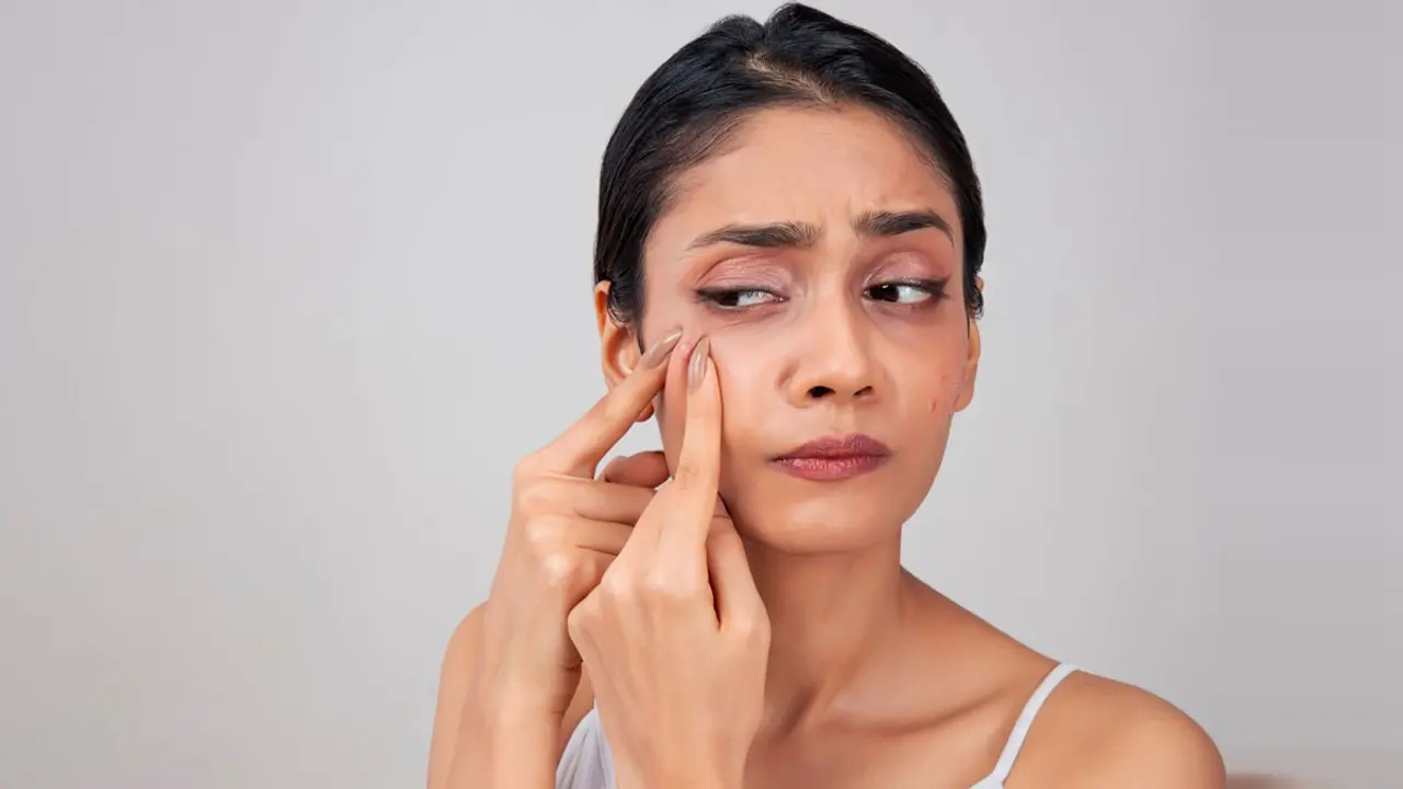 ব্রণ দূর করার উপায়