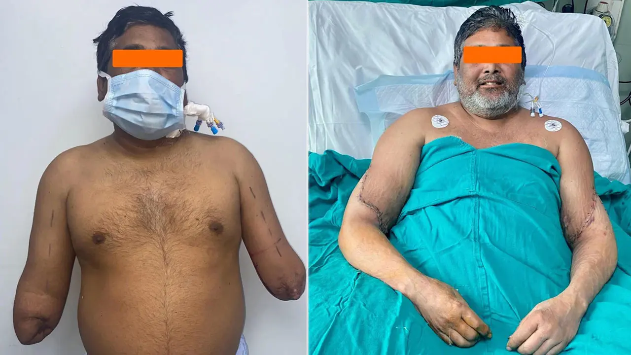 নারীর দান করা দুই হাত জোড়া লাগল পুরুষের শরীরে