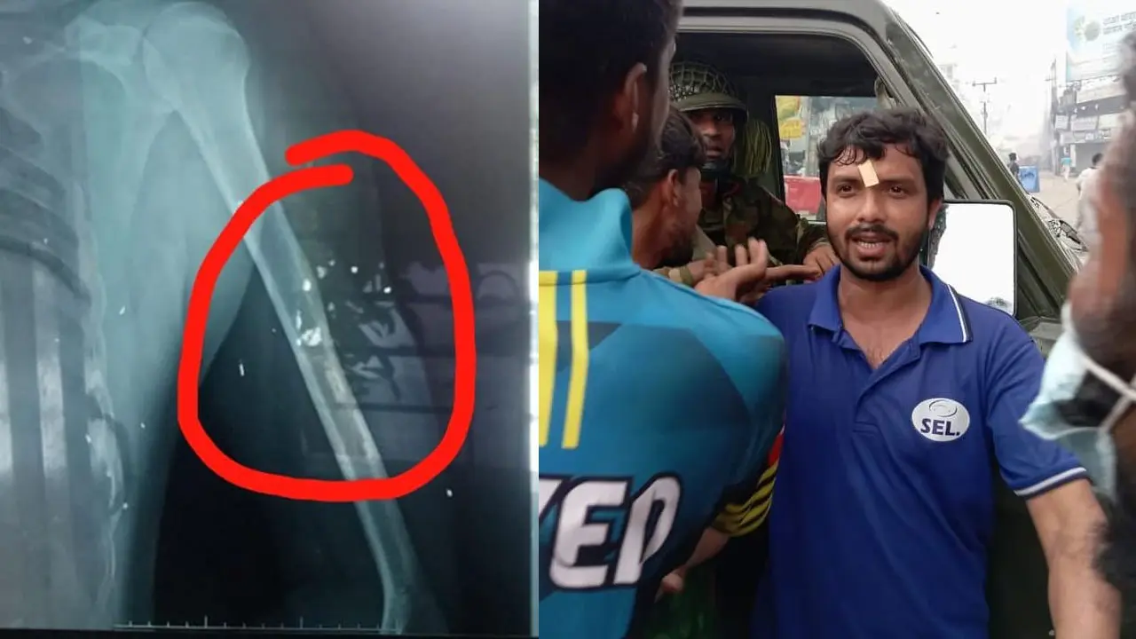এখনো শরীরে ২২টি ছররা গুলি বয়ে বেড়াচ্ছেন জুলাইযোদ্ধা আলাউদ্দিন