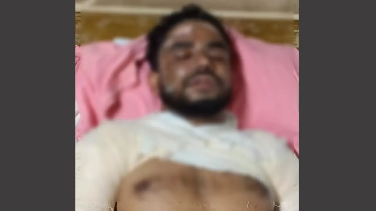মেয়ের ছোড়া গরম তেলে ঝলসে গেলেন বাবা