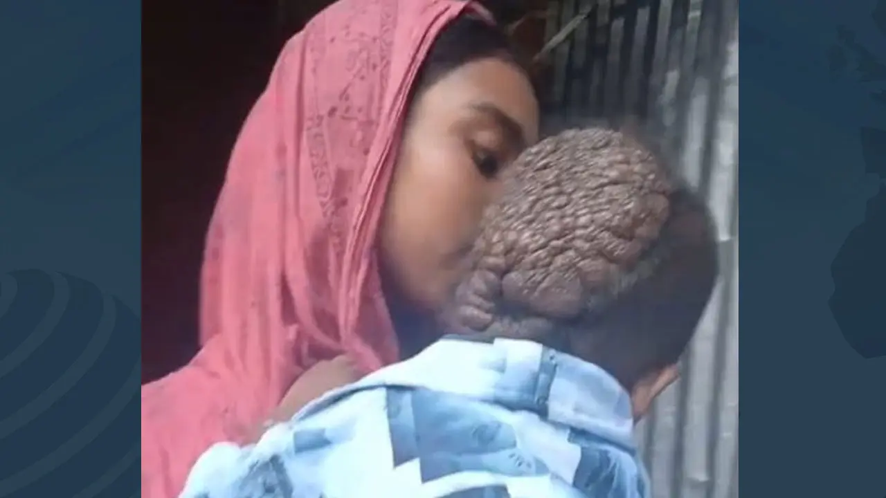 ১৫ মাসের শিশুর মাথাজুড়ে বাসা বেঁধেছে বিরল রোগ, অর্থাভাবে চিকিৎসা বন্ধ