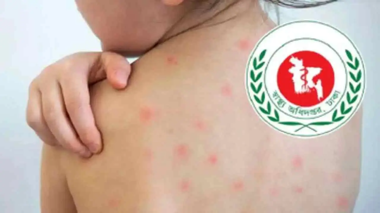 হাম উপসর্গে আরও ৬ শিশুর মৃত্যু