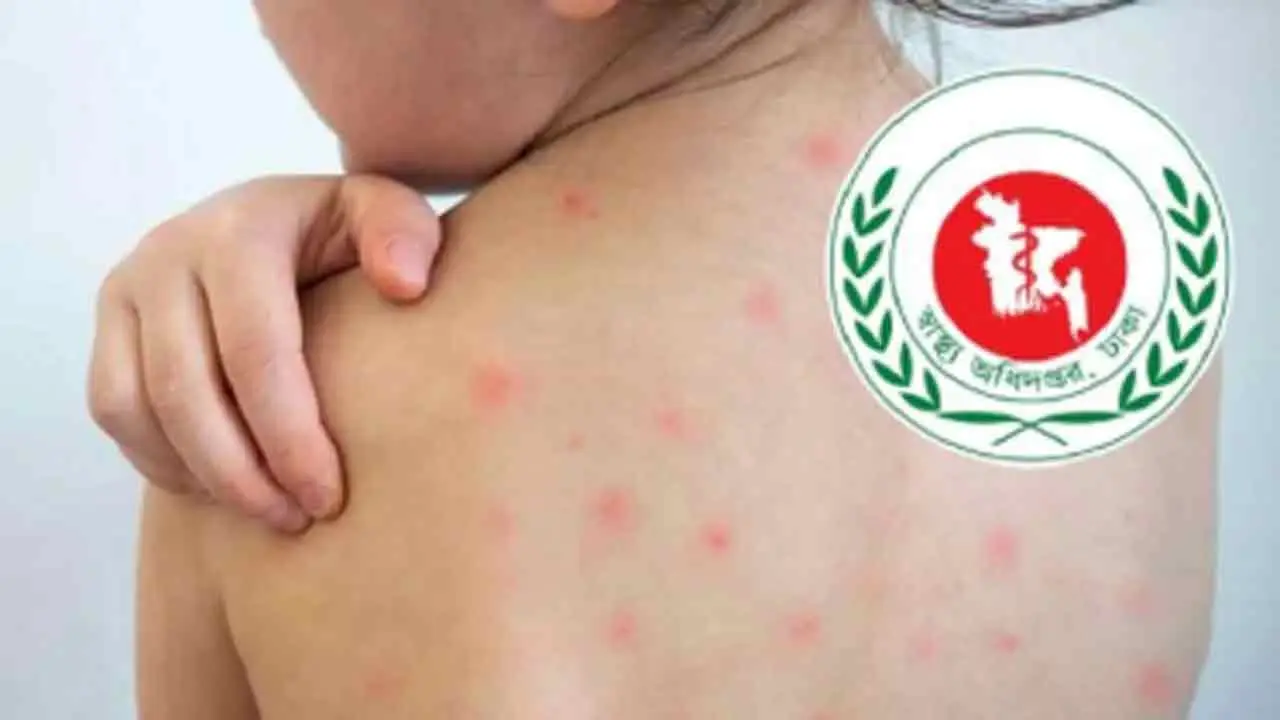 হাম উপসর্গে আরও ৪ শিশুর মৃত্যু, আক্রান্ত ১১৪৫