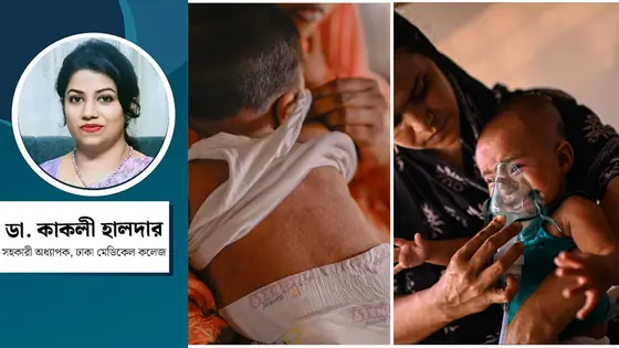 হামের প্রকোপ : জনস্বাস্থ্যে উদ্বেগ ও আমাদের করণীয়